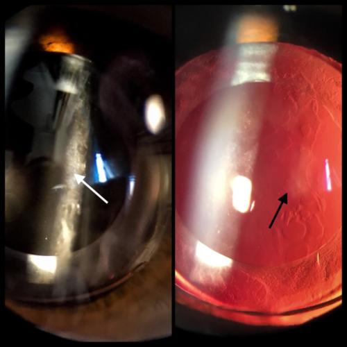 Cataract - secondary - posterior capsule opacification (PCO)